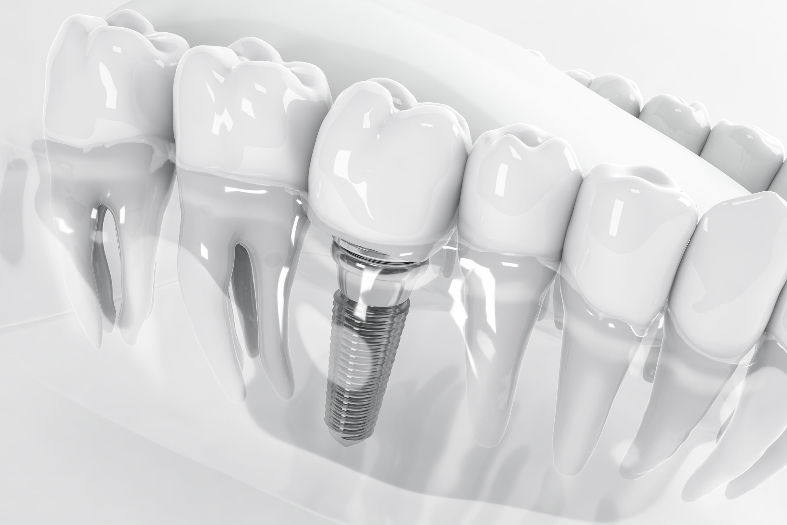Zahnimplantat in Berlin - 3D-Illustration eines im Kieferknochen fixierten Implantats