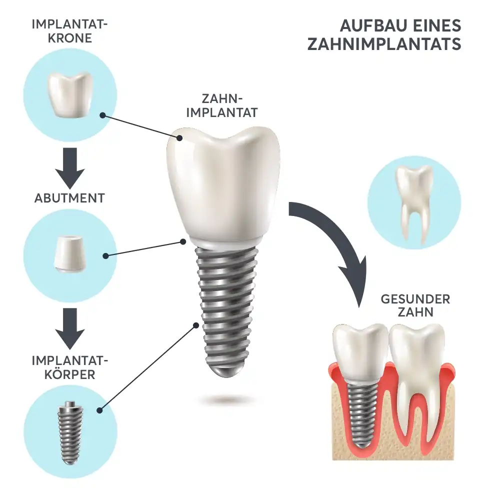 Illustration Aufbaus Zahnimplantat Berlin mit Implantatkörper, Abutment und Krone